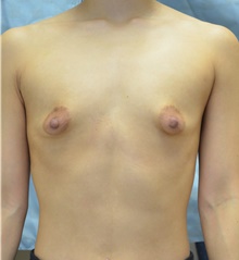 Breast Augmentation Before Photo by Mark McRae, MD, FRCS(C); Burlington, ON - Case 44331