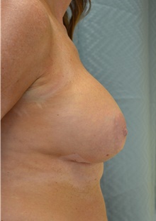Breast Augmentation After Photo by Mark McRae, MD, FRCS(C); Burlington, ON - Case 44336