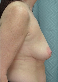 Breast Augmentation Before Photo by Mark McRae, MD, FRCS(C); Burlington, ON - Case 44336