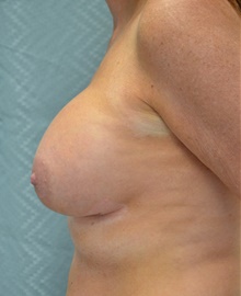 Breast Augmentation After Photo by Mark McRae, MD, FRCS(C); Burlington, ON - Case 44336