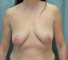 Breast Augmentation Before Photo by Mark McRae, MD, FRCS(C); Burlington, ON - Case 44336