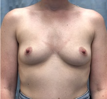 Breast Augmentation Before Photo by Mark McRae, MD, FRCS(C); Burlington, ON - Case 44722
