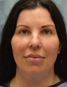 Neck Lift After Photo by Mark McRae, MD, FRCS(C); Burlington, ON - Case 45212