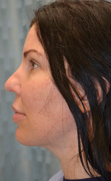 Neck Lift After Photo by Mark McRae, MD, FRCS(C); Burlington, ON - Case 45212