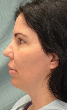 Neck Lift Before Photo by Mark McRae, MD, FRCS(C); Burlington, ON - Case 45212