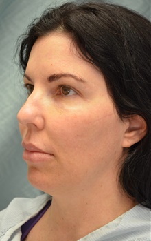 Neck Lift Before Photo by Mark McRae, MD, FRCS(C); Burlington, ON - Case 45212