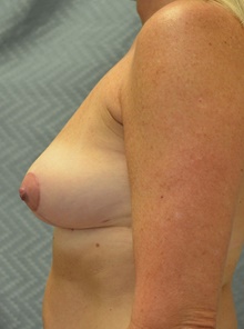 Breast Lift After Photo by Mark McRae, MD, FRCS(C); Hamilton, ON - Case 45214