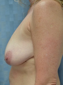 Breast Lift Before Photo by Mark McRae, MD, FRCS(C); Hamilton, ON - Case 45214