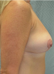 Breast Lift After Photo by Mark McRae, MD, FRCS(C); Burlington, ON - Case 45214