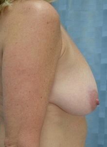 Breast Lift Before Photo by Mark McRae, MD, FRCS(C); Burlington, ON - Case 45214