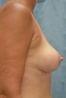 Breast Implant Removal After Photo by Mark McRae, MD, FRCS(C); Burlington, ON - Case 45404