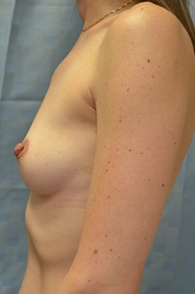 Breast Augmentation Before Photo by Mark McRae, MD, FRCS(C); Burlington, ON - Case 45900