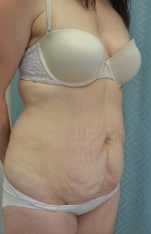 Tummy Tuck Before Photo by Mark McRae, MD, FRCS(C); Burlington, ON - Case 45902