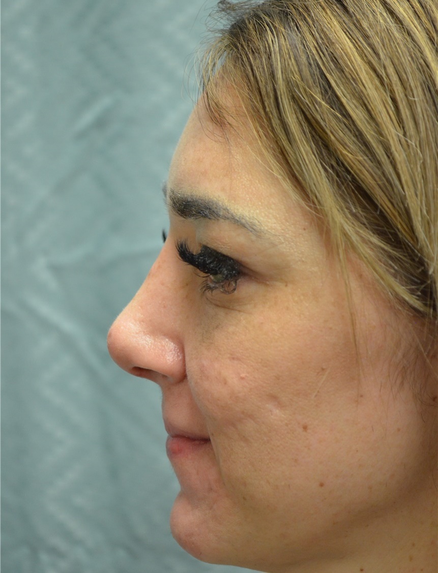 Shape, Lift, Contour the Face - Burlington Plastic Surgery