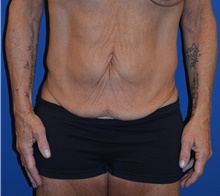 Tummy Tuck Before Photo by Mark McRae, MD, FRCS(C); Hamilton, ON - Case 46305