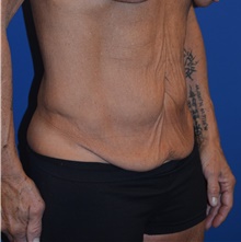 Tummy Tuck Before Photo by Mark McRae, MD, FRCS(C); Burlington, ON - Case 46305