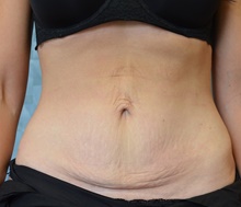 Tummy Tuck Before Photo by Mark McRae, MD, FRCS(C); Burlington, ON - Case 46393