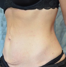 Tummy Tuck Before Photo by Mark McRae, MD, FRCS(C); Burlington, ON - Case 46393