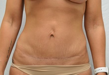 Tummy Tuck After Photo by Mark McRae, MD, FRCS(C); Burlington, ON - Case 46393