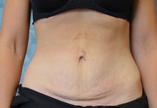 Tummy Tuck Before Photo by Mark McRae, MD, FRCS(C); Burlington, ON - Case 46393