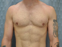 Male Breast Reduction After Photo by Mark McRae, MD, FRCS(C); Burlington, ON - Case 46513