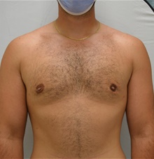 Male Breast Reduction After Photo by Mark McRae, MD, FRCS(C); Burlington, ON - Case 46595