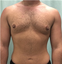 Male Breast Reduction Before Photo by Mark McRae, MD, FRCS(C); Burlington, ON - Case 46595