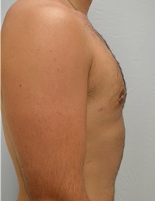 Male Breast Reduction After Photo by Mark McRae, MD, FRCS(C); Burlington, ON - Case 46595