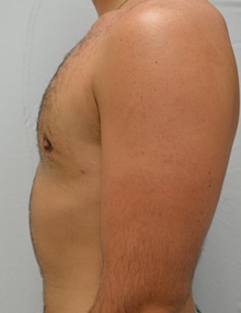 Male Breast Reduction After Photo by Mark McRae, MD, FRCS(C); Burlington, ON - Case 46595