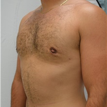 Male Breast Reduction After Photo by Mark McRae, MD, FRCS(C); Burlington, ON - Case 46595