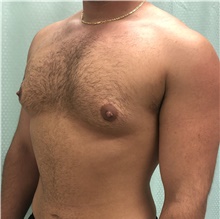 Male Breast Reduction Before Photo by Mark McRae, MD, FRCS(C); Burlington, ON - Case 46595