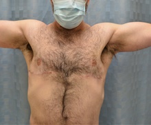 Male Breast Reduction After Photo by Mark McRae, MD, FRCS(C); Burlington, ON - Case 46600
