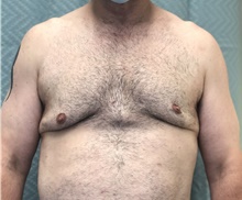 Male Breast Reduction Before Photo by Mark McRae, MD, FRCS(C); Burlington, ON - Case 46600