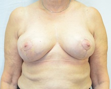 Breast Reduction After Photo by Mark McRae, MD, FRCS(C); Burlington, ON - Case 46663