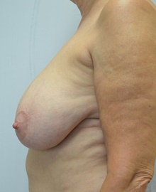 Breast Reduction Before Photo by Mark McRae, MD, FRCS(C); Burlington, ON - Case 46663