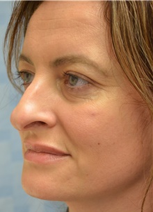 Rhinoplasty Before Photo by Mark McRae, MD, FRCS(C); Burlington, ON - Case 46666