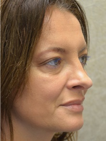 Rhinoplasty After Photo by Mark McRae, MD, FRCS(C); Burlington, ON - Case 46666