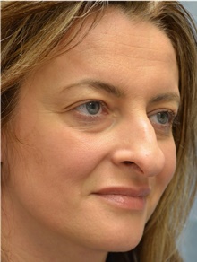 Rhinoplasty Before Photo by Mark McRae, MD, FRCS(C); Burlington, ON - Case 46666