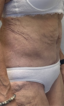 Tummy Tuck After Photo by Mark McRae, MD, FRCS(C); Burlington, ON - Case 46995