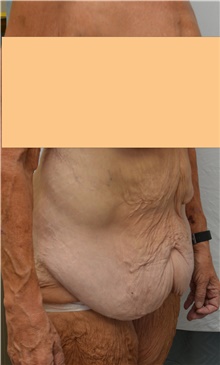 Tummy Tuck Before Photo by Mark McRae, MD, FRCS(C); Burlington, ON - Case 46995