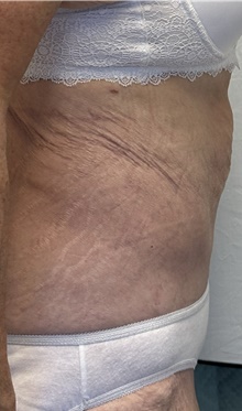 Tummy Tuck After Photo by Mark McRae, MD, FRCS(C); Burlington, ON - Case 46995