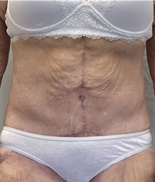 Tummy Tuck After Photo by Mark McRae, MD, FRCS(C); Burlington, ON - Case 46995