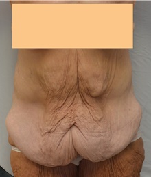 Tummy Tuck Before Photo by Mark McRae, MD, FRCS(C); Burlington, ON - Case 46995