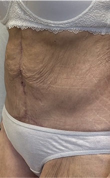 Tummy Tuck After Photo by Mark McRae, MD, FRCS(C); Burlington, ON - Case 46995