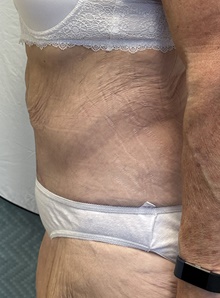 Tummy Tuck After Photo by Mark McRae, MD, FRCS(C); Burlington, ON - Case 46995