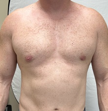 Male Breast Reduction After Photo by Mark McRae, MD, FRCS(C); Burlington, ON - Case 47135
