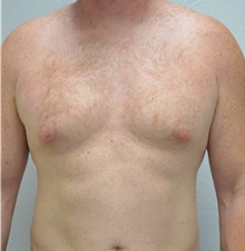 Male Breast Reduction Before Photo by Mark McRae, MD, FRCS(C); Burlington, ON - Case 47135
