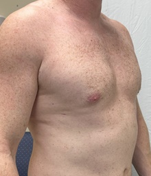Male Breast Reduction After Photo by Mark McRae, MD, FRCS(C); Burlington, ON - Case 47135