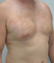 Male Breast Reduction Before Photo by Mark McRae, MD, FRCS(C); Burlington, ON - Case 47135