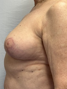 Breast Lift After Photo by Mark McRae, MD, FRCS(C); Burlington, ON - Case 47499